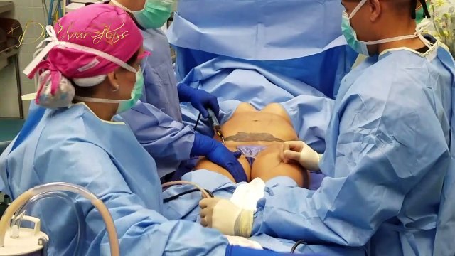 Liposuction or thigh lift to achieve slimmer legs