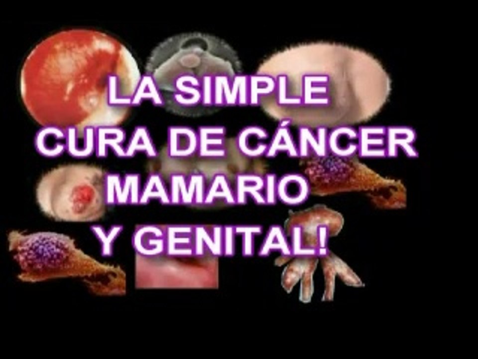 CAUSAS Y  SIMPLE CURA DEL CÁNCER MAMARIO. Y GENITAL.