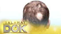 Types of alopecia, and different ways to prevent and treat the hair condition | Salamat Dok