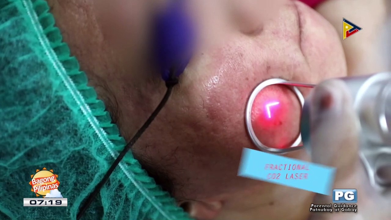DERMAESTHETIQUE: Fractional CO2 laser
