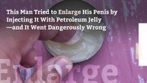 This Man Tried to Enlarge His Penis by Injecting It With Petroleum Jelly—and It Went Dangerously Wrong
