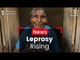 New Cases Of Leprosy