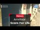 Amritsar Tragedy: Scars For Life