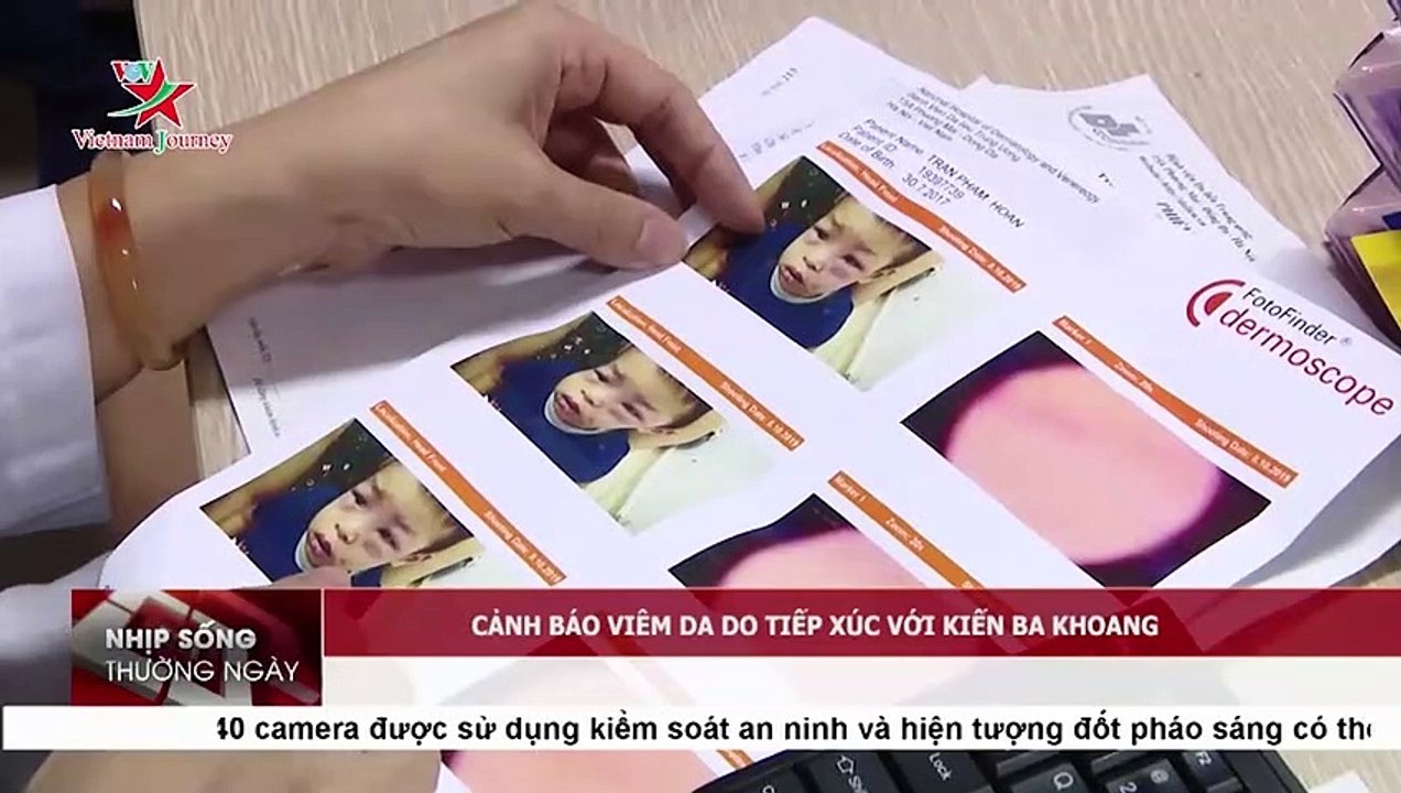 Cảnh báo viêm da do tiếp xúc với kiến ba khoang
