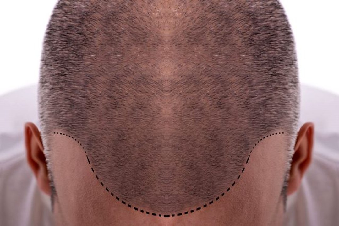 Saç ekimi nedir, saç ekimi nasıl yapılır? Saç ekimi fiyatları ve saç ekimi sonuçları