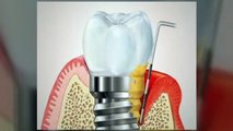 Replace Missing Teeth With Dental Implants Treatment