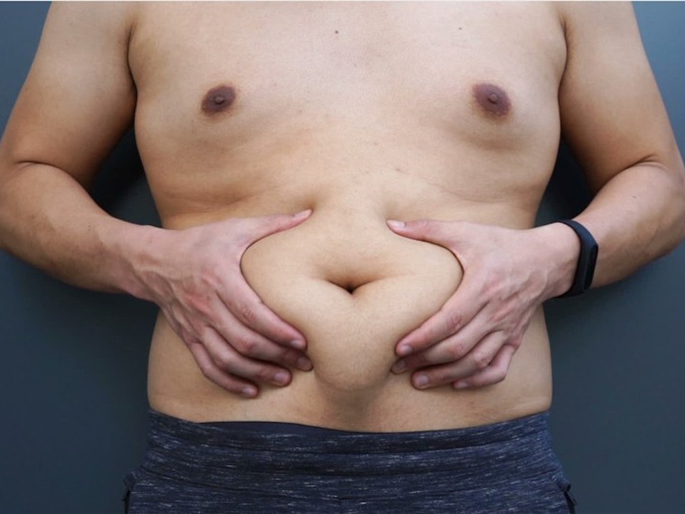 431 Euro pro Jahr: Fettleibigkeit hat wirtschaftliche Folgen