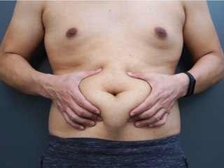 431 Euro pro Jahr: Fettleibigkeit hat wirtschaftliche Folgen