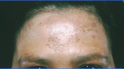 bd-melasma-causas-tratamientos-101019