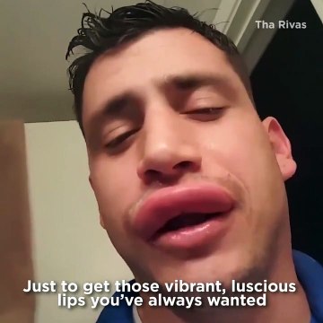 La piqure d'abeille sur les lèvres : mieux que le botox