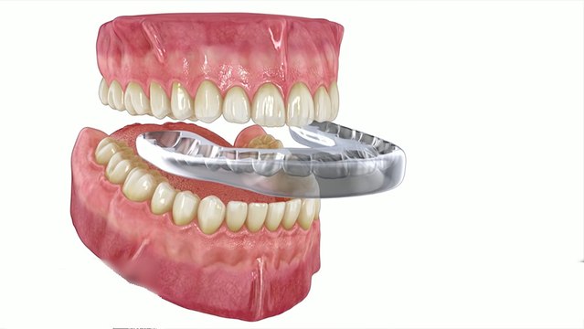 bd-tratamientos-para-bruxismo-141019