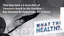 This Man Had a 3-Inch Pair of Tweezers Stuck in His Urethra—But Showed No Symptoms for 4 Years