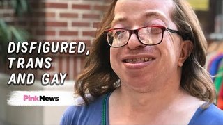 Surviving gender dysphoria as a disfigured, transgender, gay woman