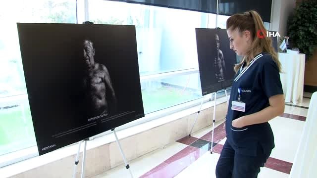 Meme kanseri erkeklerde de görülebiliyor