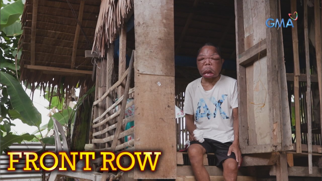 Front Row: Lalaki sa Ormoc City, nagkaroon ng sipon, namaga ang ilong at lumobo ang mukha?Front Row: Lalaki sa Ormoc City, nagkaroon ng sipon, namaga ang ilong at lumobo ang mukha?