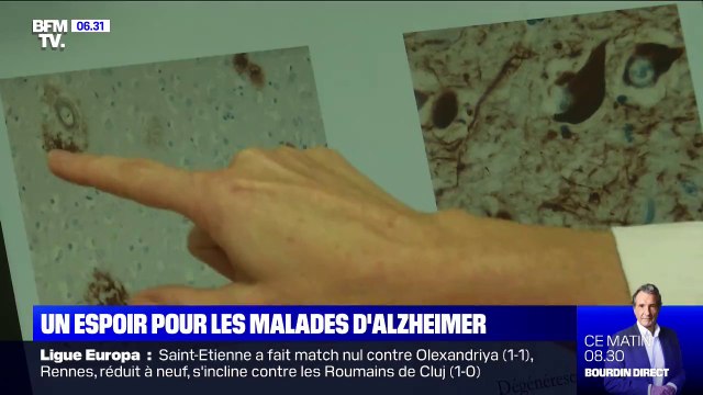 Alzheimer: pour la première fois, un laboratoire américain réussit à faire reculer la maladie et ses symptômes