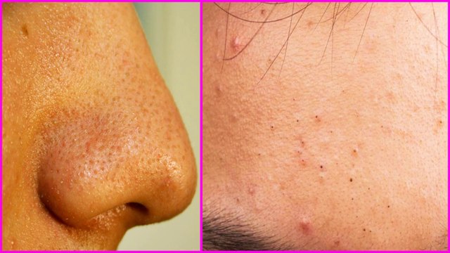 5 Effective Natural Home Remedies To Get Rid Of Nose Blackheads