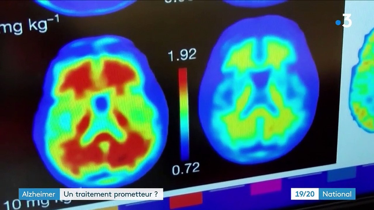 Alzheimer : une molécule redonne espoir aux chercheurs