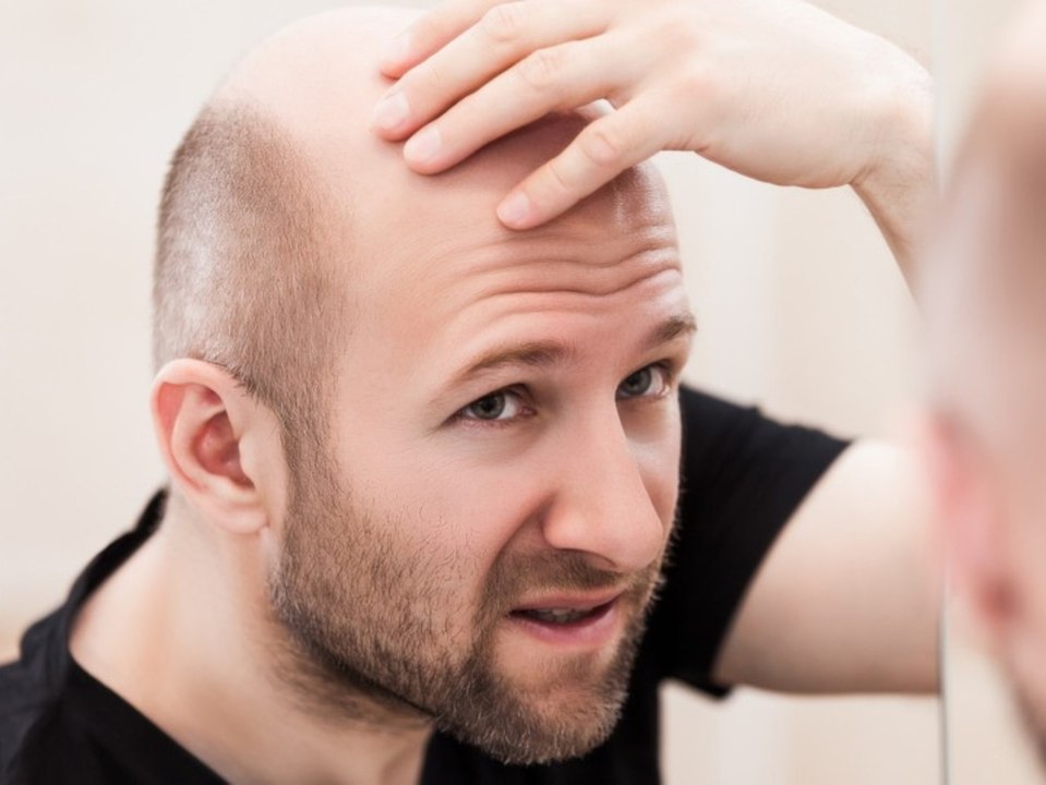 Zu viel Arbeit begünstigt Haarausfall bei Männern