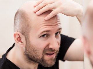 Zu viel Arbeit begünstigt Haarausfall bei Männern