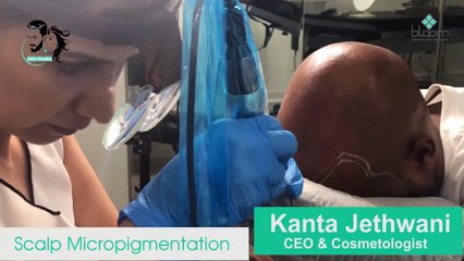 Scalp Micropigmentation