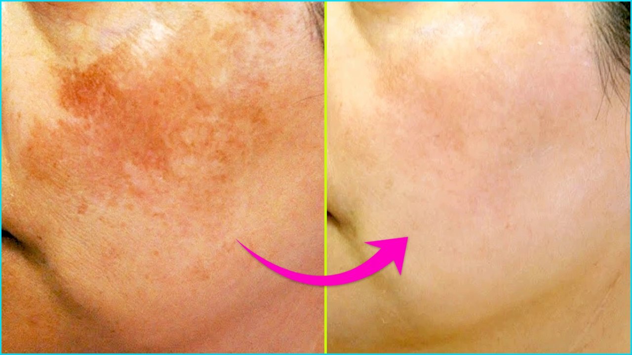 5 Simple Home Remedies To Treat Skin Pigmentation Naturally
