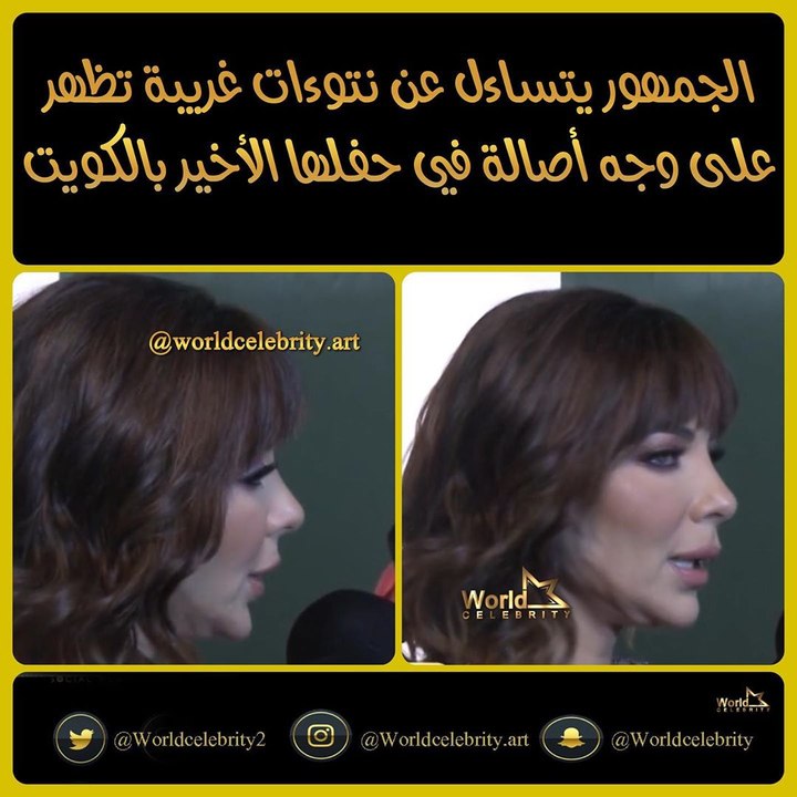 أصالة تظهر بوجه تغطيه النتوءات والعظام البارزة.. والجمهور مصدوم