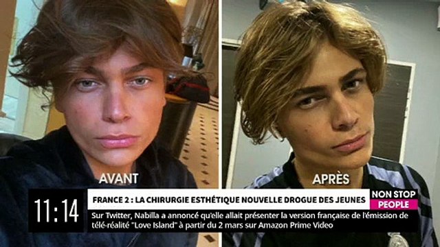 Le témoignage de Robin qui multiplient les opérations de chirurgie esthétique à 18 ans avec un objectif, faire de la télé-réalité !