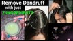 Magical Home Remedy to Remove DANDRUFF at home Dandruff treatment How to get rid of dandruff