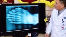 Chinese man with nine toes on one foot has surgery to remove the extras