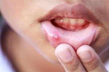 ¿Cómo deshacerse de las úlceras bucales?
