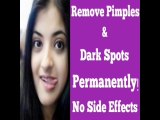 HOW TO REMOVE PIMPLES & ACNE COMPLETELY IN JUST 3 DAYS | GET RID OF ACNE & PIMPLE MARKS EASY AND NATURALLY | HINDI