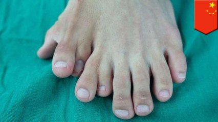 Man with 9 toes on left foot has surgery to remove freeloaders