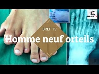 Un homme avec neuf orteils sur un pied subit une intervention chirurgicale qui change sa vie et lui