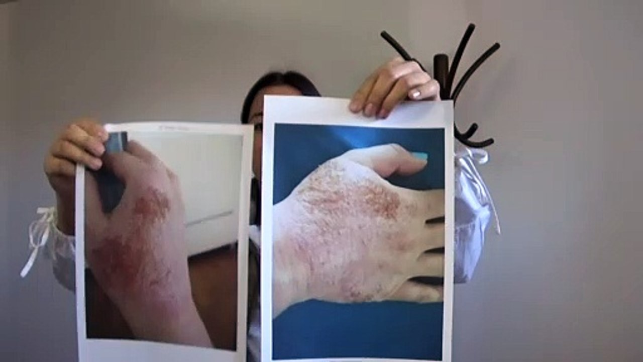 Dermatitis,eczema(егзема) izlecil IVAN ISCELITEL ©