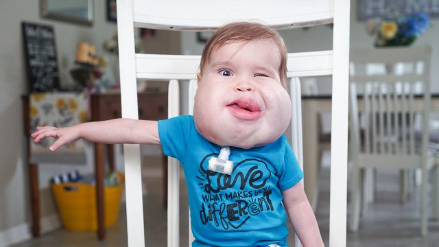 Gavin: Our Little Boy With Facial Cysts