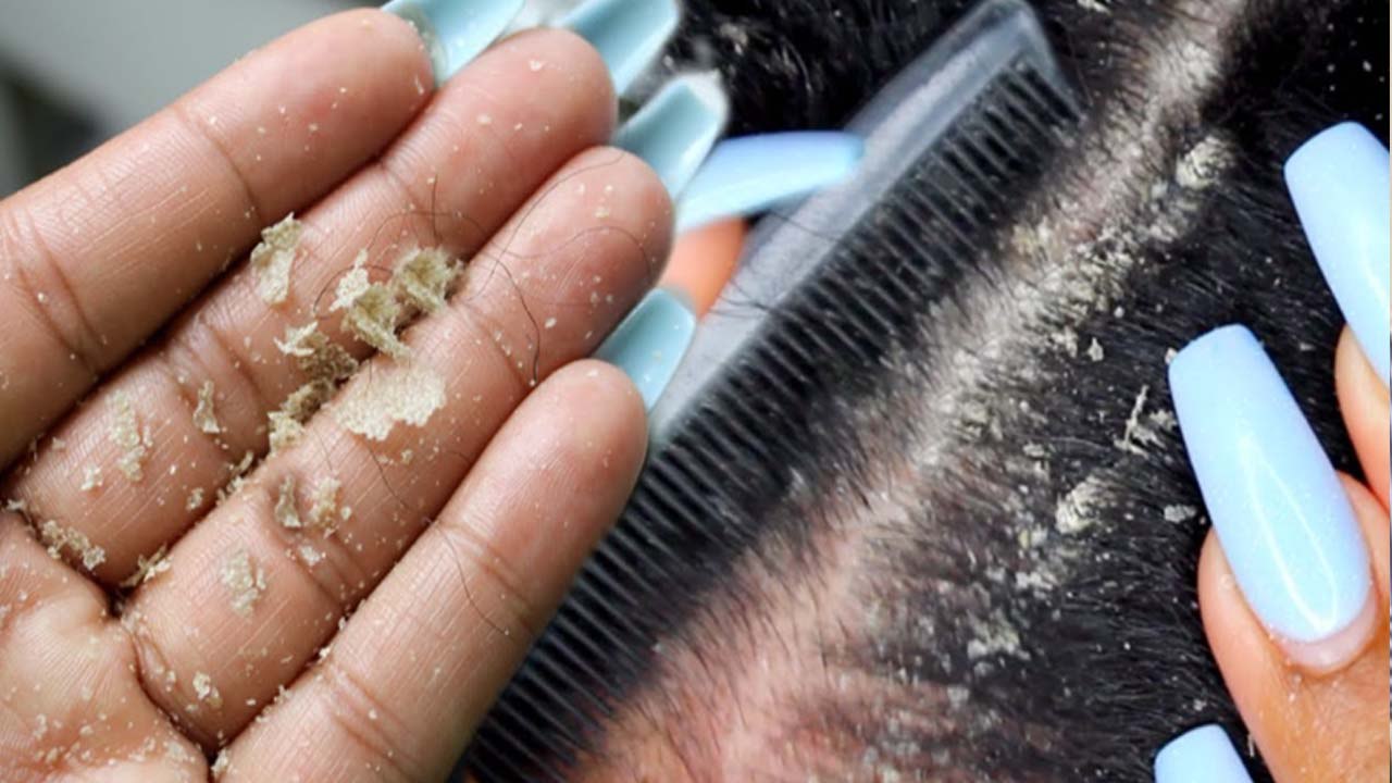 डैंड्रफ से निजात दिलाएंगे ये उपाय | Dandruff special remedy | Dandruff types remedy | Boldsky