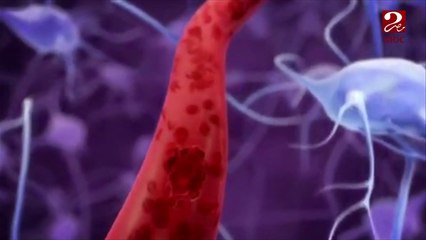 فيديو توضيحي لجلطة المخ وكيفية الوقاية منها