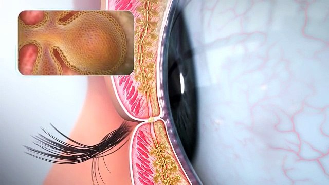 Home Remedies for Dry Eye - Cause - Symptoms and Prevention