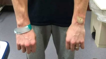 Son bracelet Fitbit explose et le brûle au 3e degré