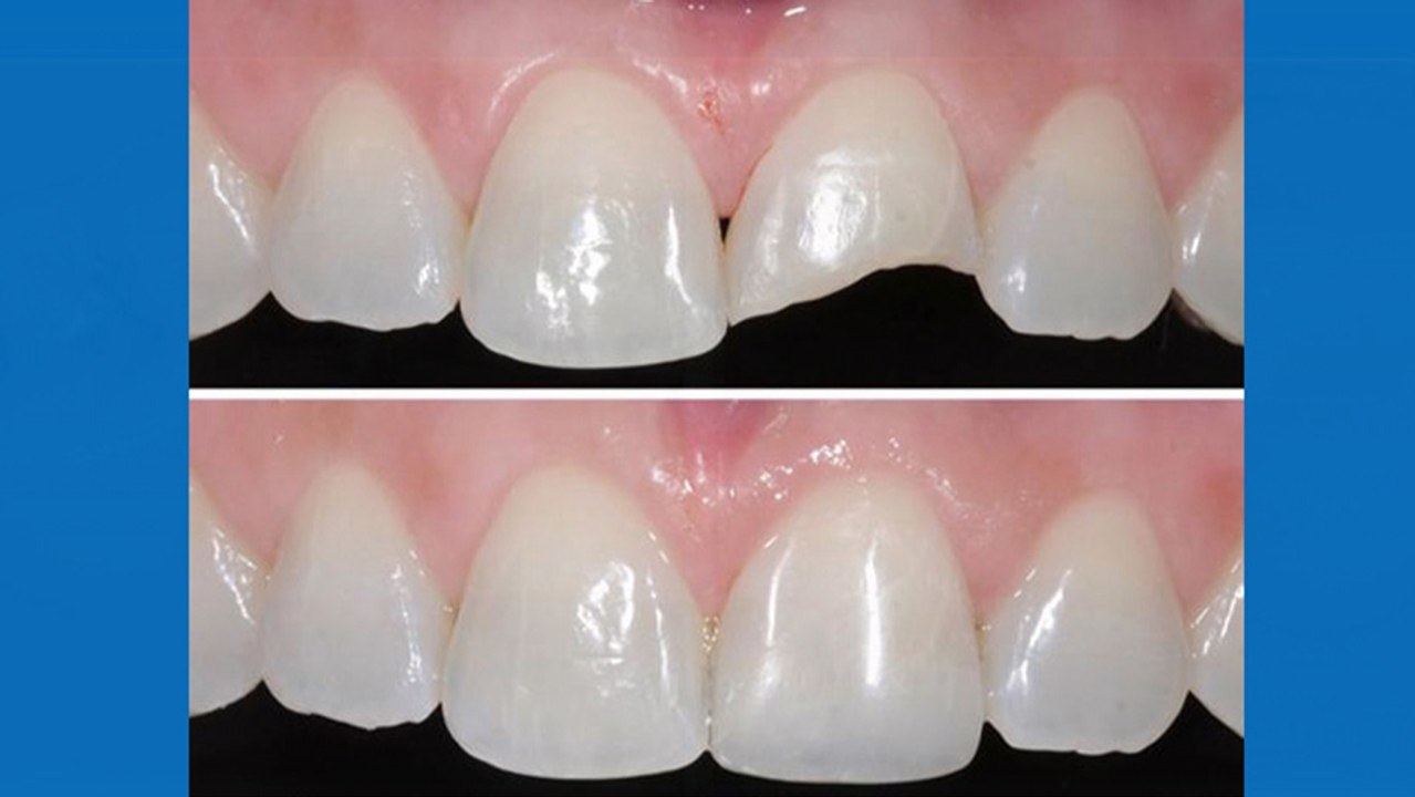 bd-tipos-de-calzas-y-cual-es-la-mejor-opcion-061119