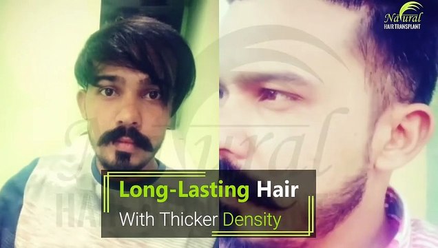 FUE Hair Transplant - Natural Hair Transplant clinic - nht india