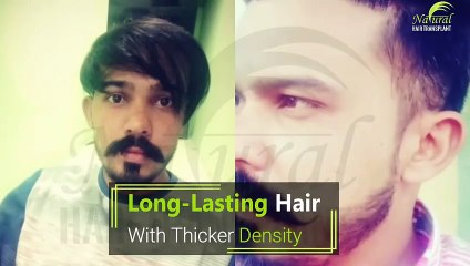 FUE Hair Transplant - Natural Hair Transplant clinic - nht india