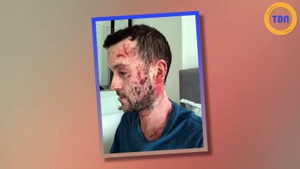 Cet homme dévoile son visage ravagé par les stéroïdes