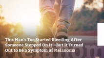 This Man's Toe Started Bleeding After Someone Stepped On It—But It Turned Out to Be a Symptom of Melanoma