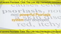 How To Cure Psoriasis Naturally Permanently- Stop Itching and Remove Psoriasis Marks From Skin