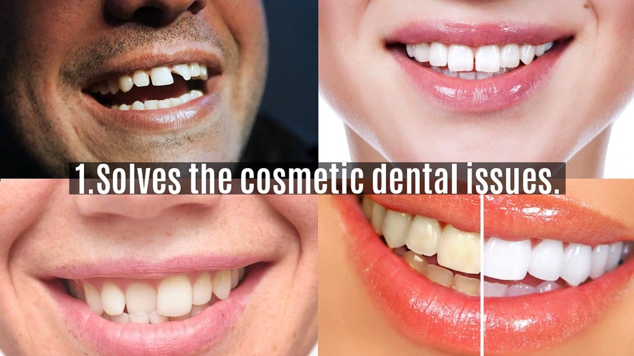 5 Benefits Of Choosing Porcelain Veneers