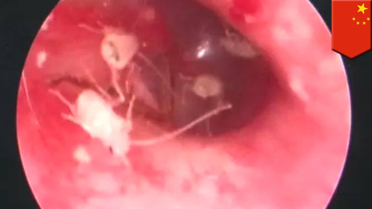 Army of cockroaches found camping out in man's ear