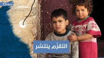 داء ينتشر بين الأطفال السوريين.. وسوء التغذية من أبرز أسبابه