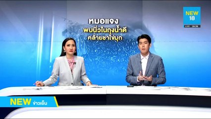 หมอแจงพบนิ่วในถุงน้ำดีคล้ายชาไข่มุก | NEW18